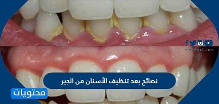 نصائح بعد تنظيف الاسنان من الجير