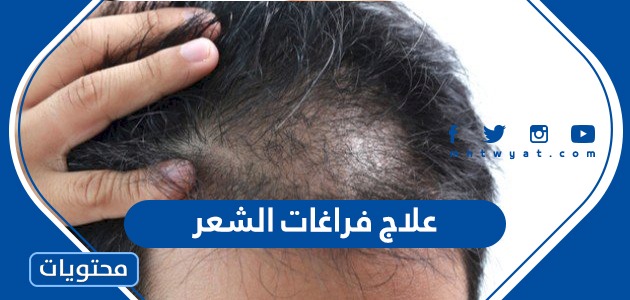 علاج فراغات الشعر بحسب السبب المؤدي للتساقط